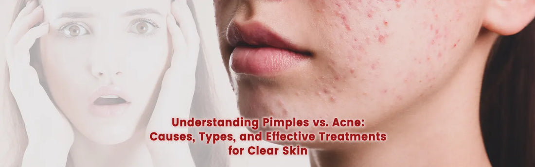 Understanding Pimples vs. Acne: Causes, Types, and Effective Treatments for Clear Skin