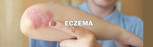 Eczema treatment in homeopathy